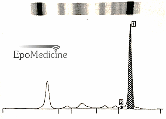 immunofixation-shows-igm-monoclonal-protein-with-kappa-light-chain