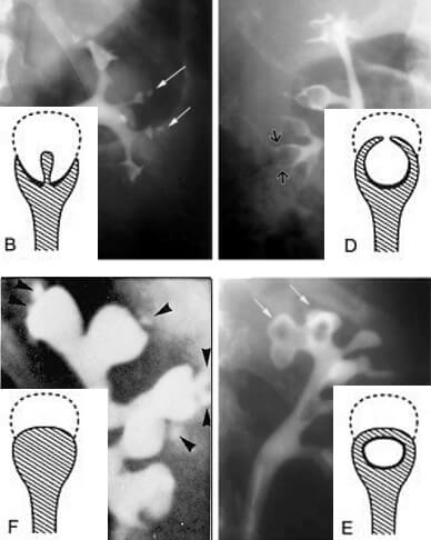 Extreme Signet Ring Cell Change in a Large B-Cell Lymphoma of Follicular  Origin | Semantic Scholar