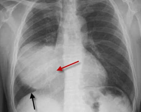 Deep sulcus sign | Lungs