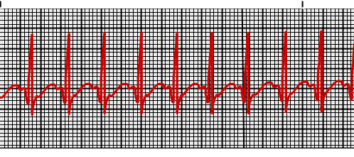 ventricular tachycardia vs supraventricular tachycardia