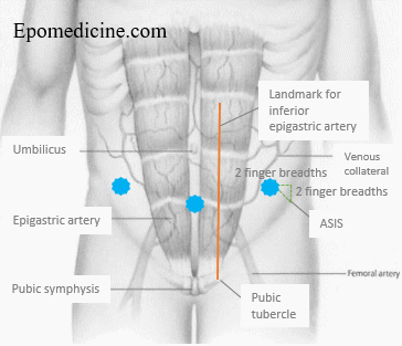 ascitic paracentesis site