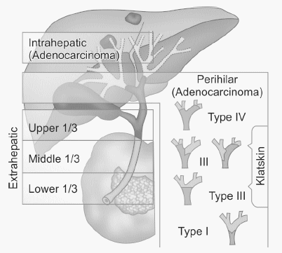 cholangiocarcinoma duct bile cancer type bismuth carcinoma classification common corlette epomedicine perihilar hepatic quick review adenocarcinoma