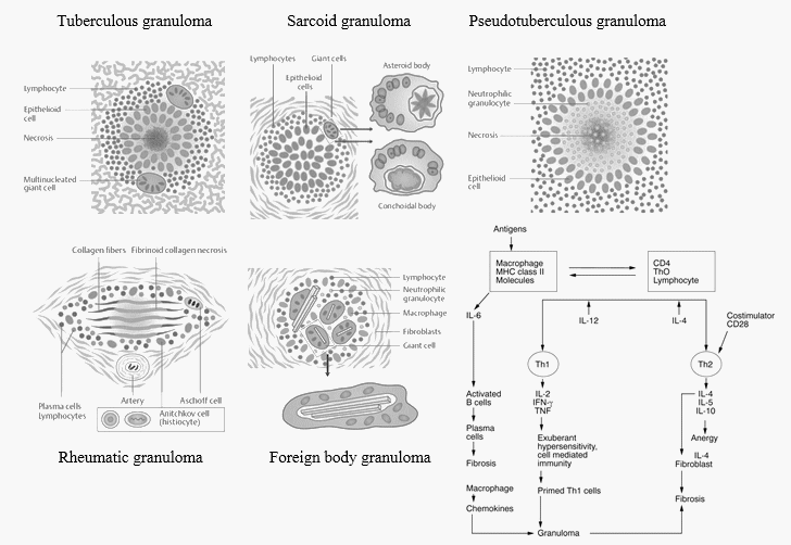 granuloma morphology pathophysiology