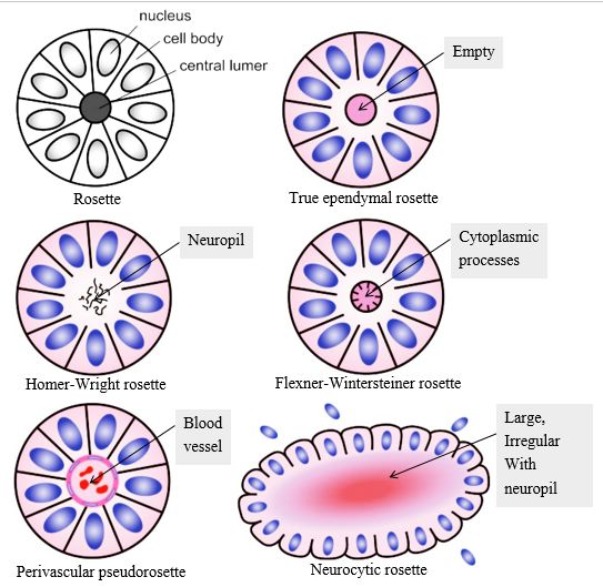 Rosettes In Pathology Epomedicine