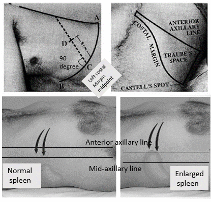 spleen percussion