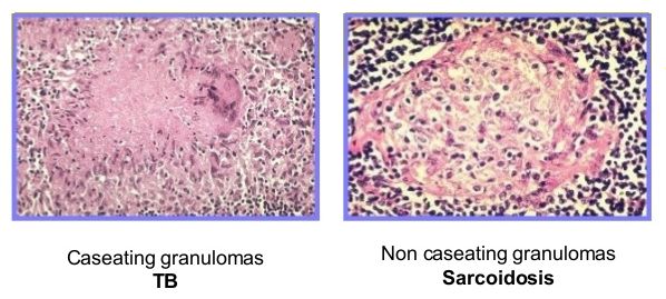 tb vs sarcoidosis