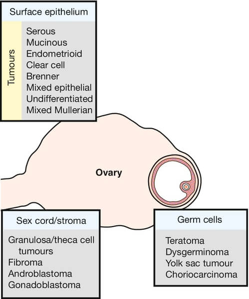 ovarian yolk sac tumor ultrasound