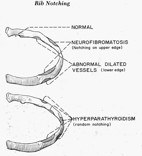 rib notching