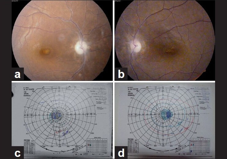 Visual field defect ethambutol