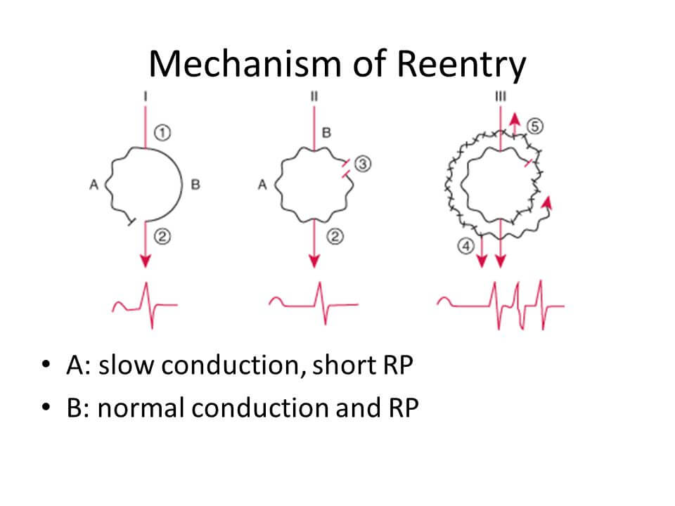 avnrt mechanism