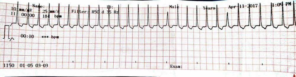 Short Approach to SVT and AVNRT management | Epomedicine