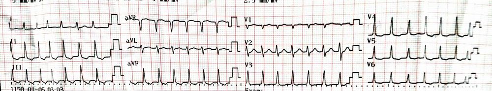 Short Approach to SVT and AVNRT management | Epomedicine