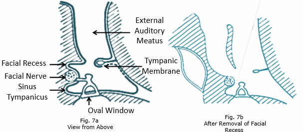 middle ear posterior wall