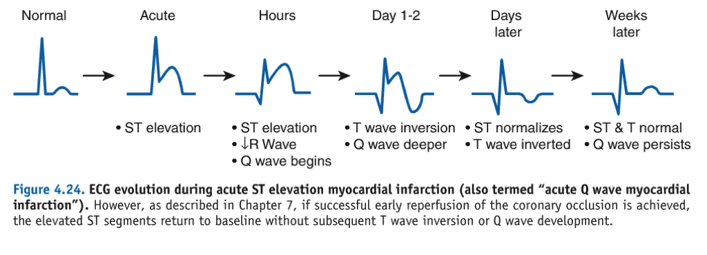 myocardial infarction ecg interpretation