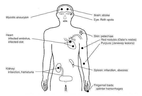 infective endocarditis