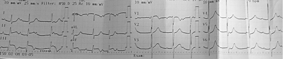 Grace Heart And Timi Score Mnemonics Cardiac Chest Pain Risk Stratification Epomedicine