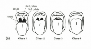 Rapid Sequence Intubation (RSI) - Mnemonic Approach | Epomedicine