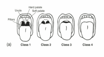 Rapid Sequence Intubation (RSI) - Mnemonic Approach | Epomedicine