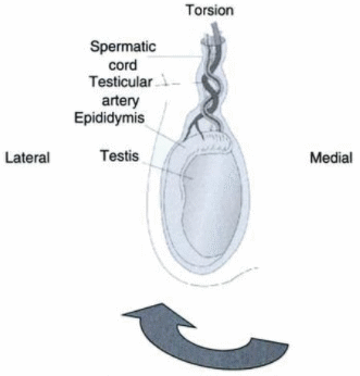 Manual detorsion of testis in Testicular Torsion | Epomedicine