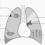 pulmonary embolism xray