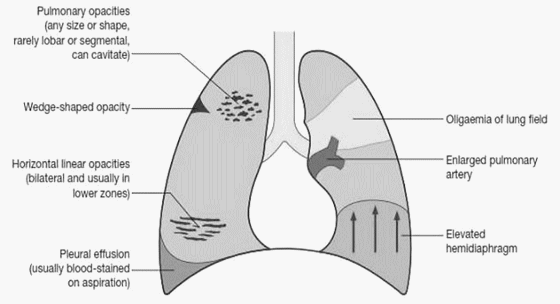 chest x ray pulmonary embolism