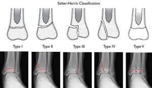 Salter Harris Classification for Physeal Fracture: Mnemonic | Epomedicine
