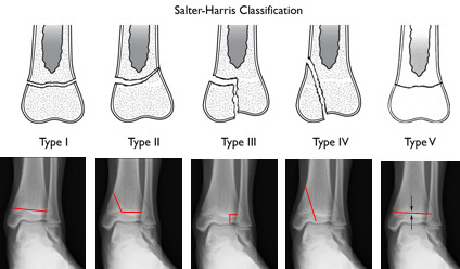 salter harris classification