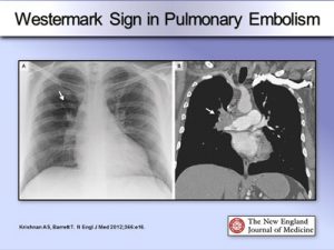 Pulmonary Embolism : Chest X-ray Signs | Epomedicine