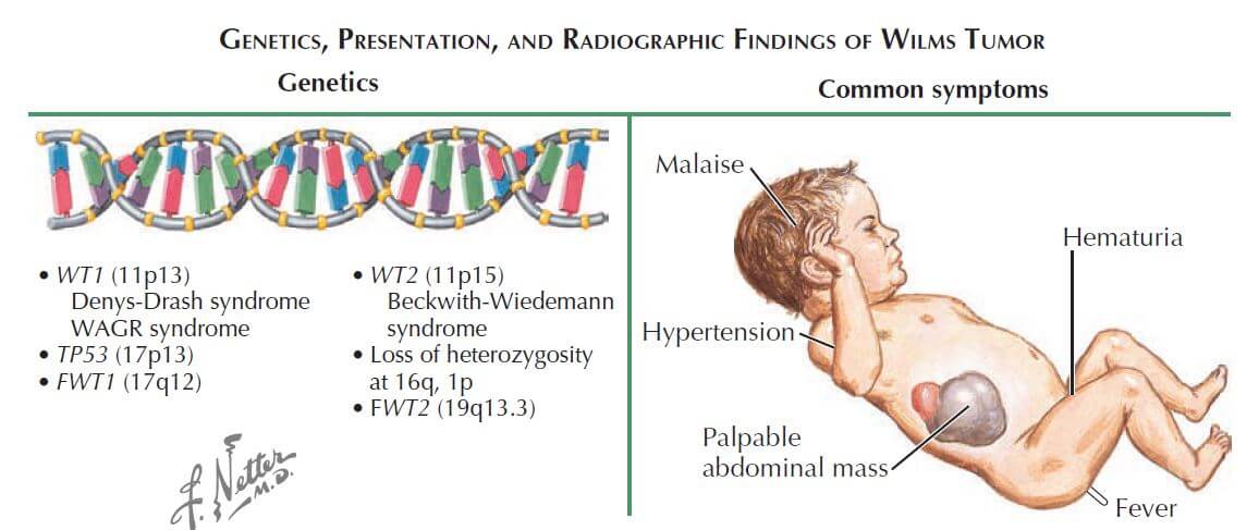 Wilm S Tumor Nephroblastoma Quick Review Epomedicine