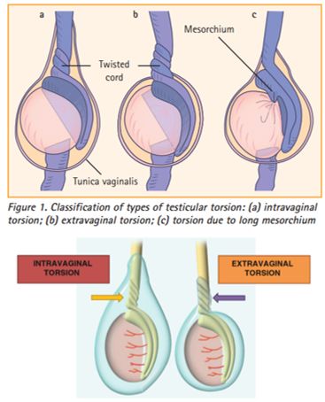 testicular torsion intravaginal