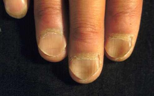 Iron Deficiency Anemia Nails