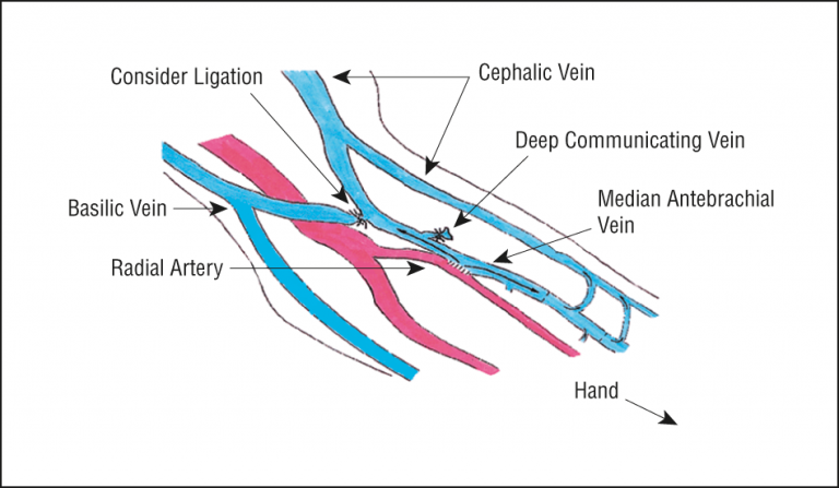 Superficial Veins Of Forearm Mnemonic Epomedicine