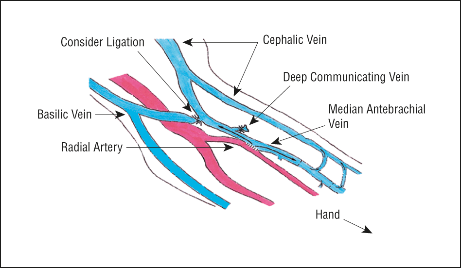 median antebrachial vein