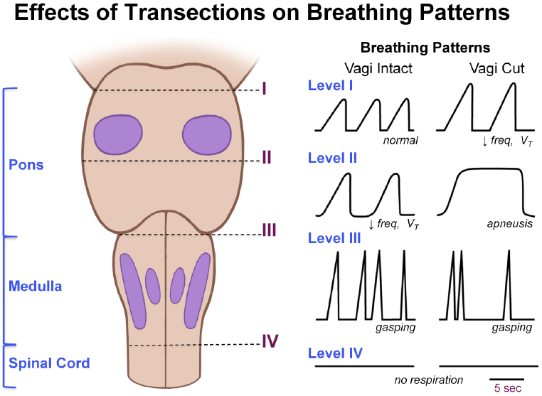 respiratory center lesion