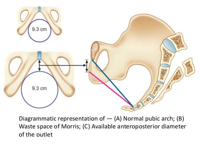 Landmarks of the Pelvic Brim, Pelvic Cavity and Pelvic Outlet