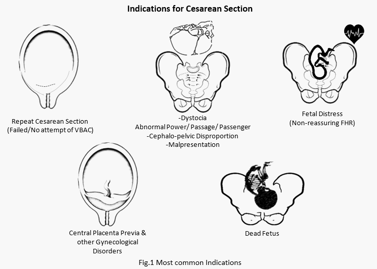Layers cut during a caesarean (c-section)