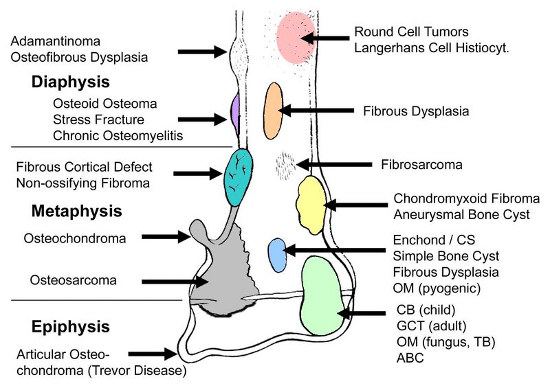 Tumor On Femur Bone Adult