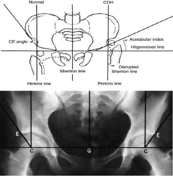 Lines And Angles In Orthopedics Epomedicine