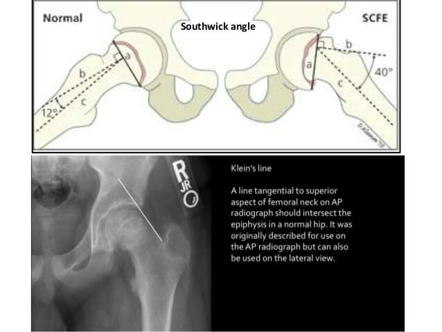 epiphysis of neck of femur