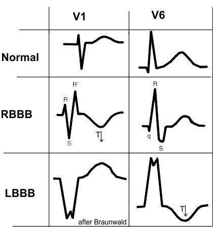 lbbb rbbb ecg