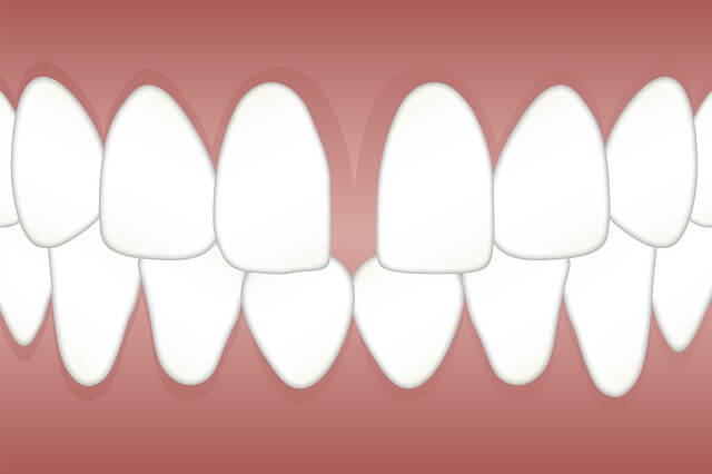 diastema