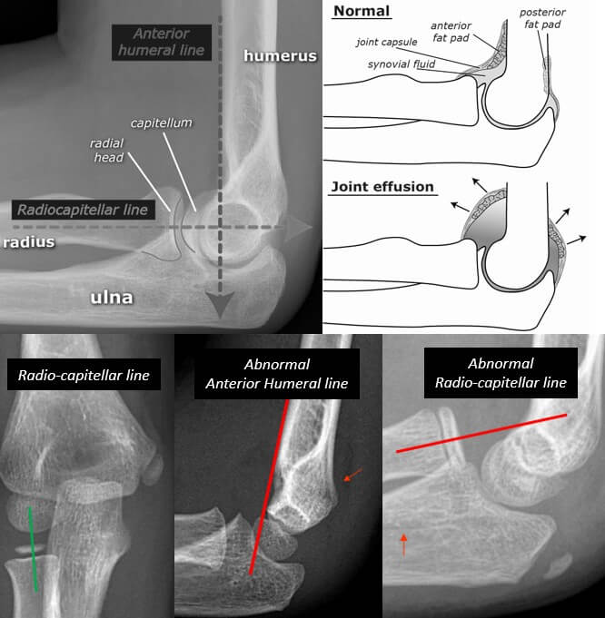 elbow xray approach
