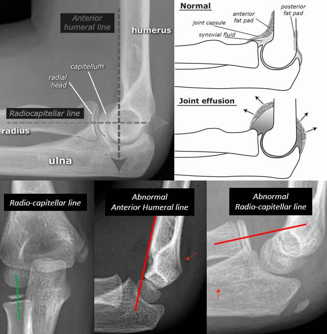 elbow anatomy xray