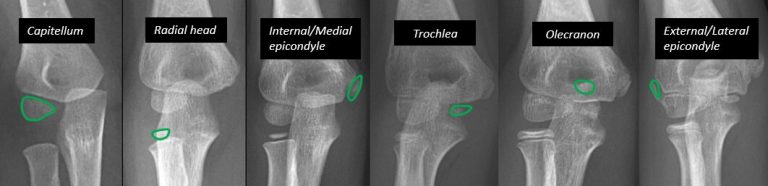 Mnemonic Approach to Elbow Xray - FOOL | Epomedicine