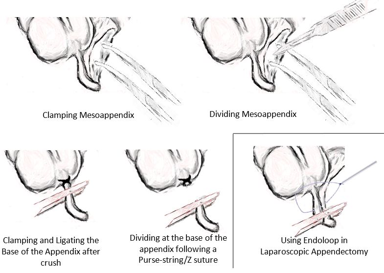 appendicectomy steps