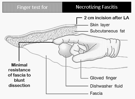 finger test for necrotizing fasciitis