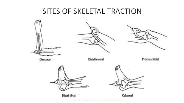 skeletal traction sites
