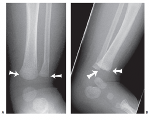 General Principles - Pediatric Fracture Management | Epomedicine