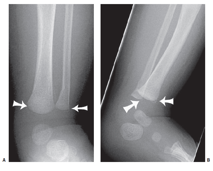 bucket handle and metaphyseal corner fracture