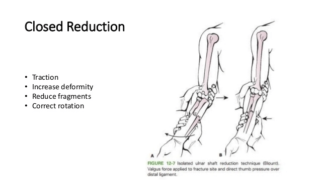 closed reduction principles